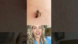 What happens when a bee stings