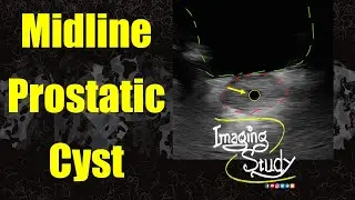 Midline Prostatic Cyst || Ultrasound || Case 349