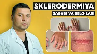Sklerodermiya kasalligi sababi, belgilari, va davosi