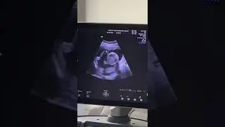 Узи,где нам сказали пол нашего малыша🙏Это самый трогательный момент 💕