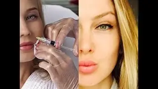 Делать ли МЕЗОТЕРАПИЮ? Как сделать кожу моложе.