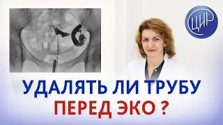 Гидросальпингс. Надо ли удалять маточную трубу перед ЭКО, если был гидросальпингс, а сейчас нет?