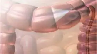 Colon Cancer
