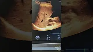 Focal Hepatic Calcifications || Ultrasound
