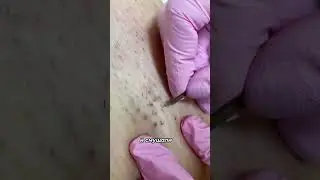 Избавляемся от вросших волос 
