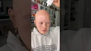 I’ve been bald for 22 YEARS