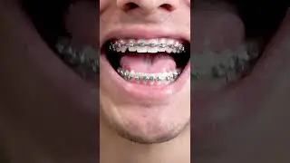 Cleaning buildup off braces with Dencle 😭