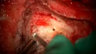 Acoustic neuroma/vestibular schwannoma surgery: Translabyrinthine approach