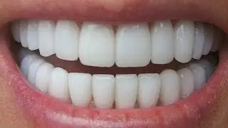 أروع 3 وصفات لتبييض الاسنان