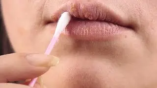 Dudağımda Uçuk Çıktı Ne Yapmalıyım?