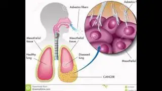 Non malignant mesothelioma