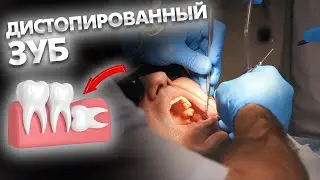 Как проходит удаление дистопированного (ретинированного) восьмого зуба?