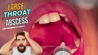 Large Throat Abscess || HUGE RELIEF after Draining a QUINSY aka PERITONSILLAR ABSCESS || Tonsillitis