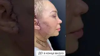 Сразу после хирургической подтяжки лица