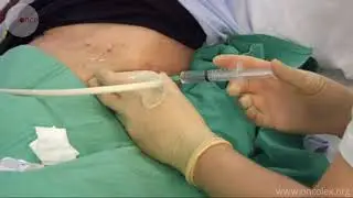 Pleural tapping; Pleural fluid aspiration; Thoracentesis