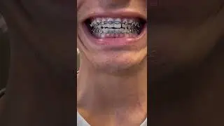 Getting my braces removed!?!??!