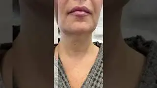 Полимолочная кислота