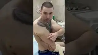 Мои руки базуки после операции. Вырезали 3 кг. вазелина