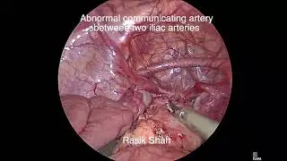 Abnormal communcating artery between two iliac arteries in a patient of common cloaca. Rasik Shah