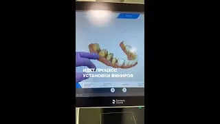 Идет процесс установки виниров