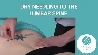 Dry Needling to the Lumbar Spine - 