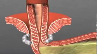 A Better Treatment for GERD: LINX Reflux Management System