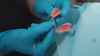 Пациент"С". 2ч. Бюгельный протез. Обучающее видео для врачей-интернов. 4-я стоматология. 22.03.2024.