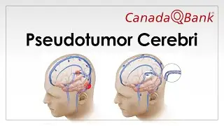 Pseudotumor Cerebri