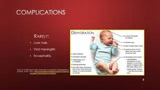 Hand, Foot, and Mouth Disease video