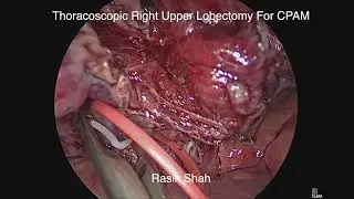 Right Upper Lobectomy for CPAM by Dr. Rasik Shah