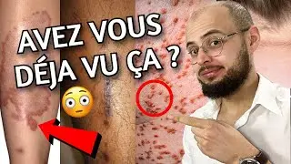 10 signes de DIABETE sur LA PEAU !