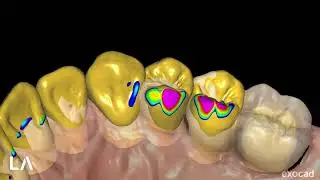 DIGITAL WAX-UP for a VENEERS Case