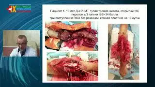 Сложные вопросы диагностики и лечения скелетной травмы в структуре политравмы у детей