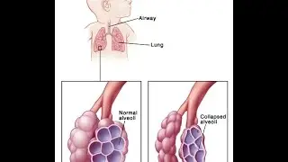 Respiratory Distress Syndrome