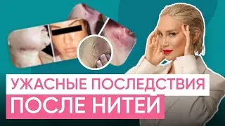 ВСЯ ПРАВДА ПРО НИТЕВОЙ ЛИФТИНГ!