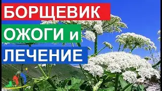 Борщевик Сосновского ожоги и лечение. Первая помощь, если Вы коснулись это ядовитое растение.