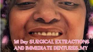 Day 1 SURGICAL EXTRACTIONS AND IMMEDIATE DENTURES...My JOURNEY