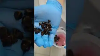 Камни из желчного пузыря. Что внутри нас 