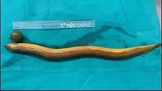 They Removed This From His Intestines 🤢