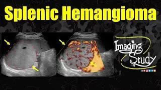 Splenic Hemangioma || Ultrasound || Case 342