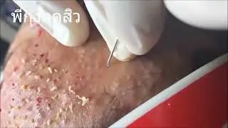 Удаление и выдавливание чёрных точек. Чистка лица. Выдавливание прыщей. Лечение акне. ЧАСТЬ 2