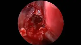 Sinus fungus ball (sphenoid mycetoma) removal