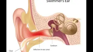 Otitis Externa