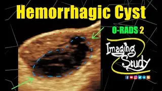 Ovarian Hemorrhagic Cyst | ORADS 2 || Ultrasound || Case 338