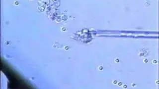 TESE (Testicular Sperm Extraction-testicular biopsy)