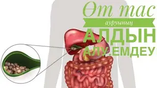 Өт тас ауруы. Себебтері.Емі.#өтке тас толу