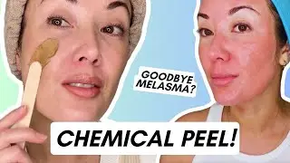 Cosmelan MD Chemical Peel: Does It Really Work for Melasma & Hyperpigmentation?
