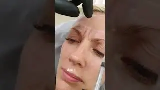 Как правильно вводить ботокс в депрессор