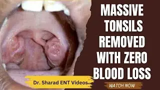 MASSIVE TONSILS Removed with ZERO BLOOD LOSS || Before & After Tonsillectomy Transformation