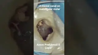 4 mesial canals on mandibular molar 